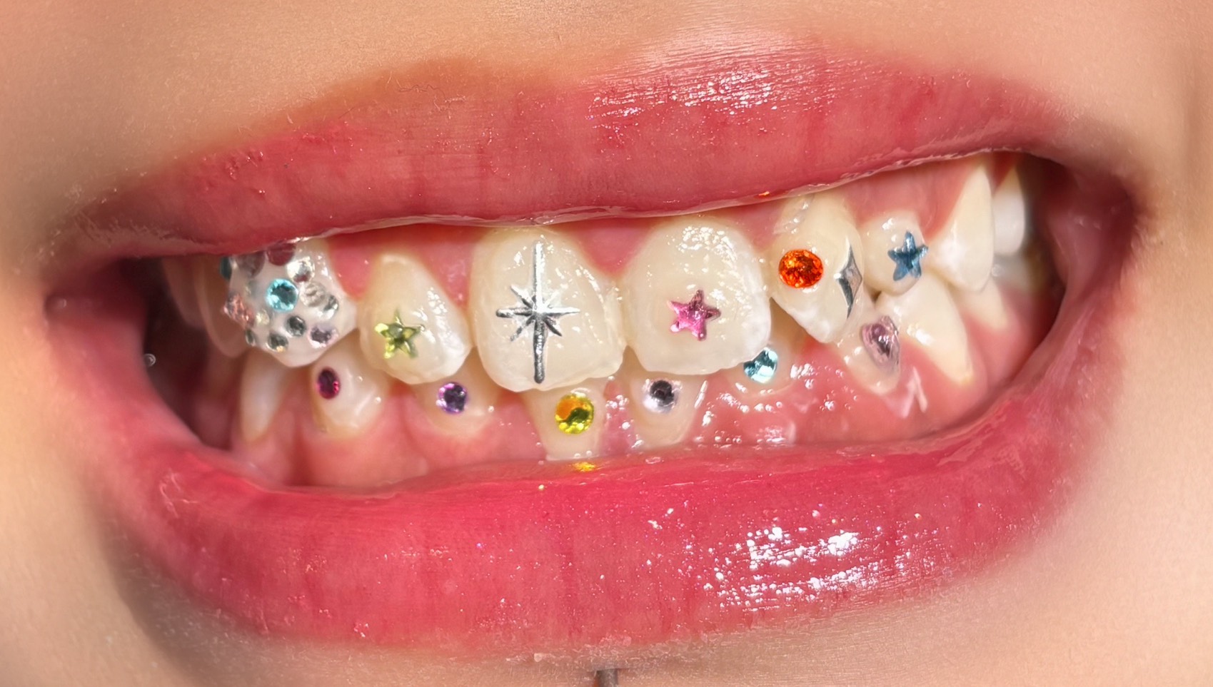 ティースジュエリー症例1