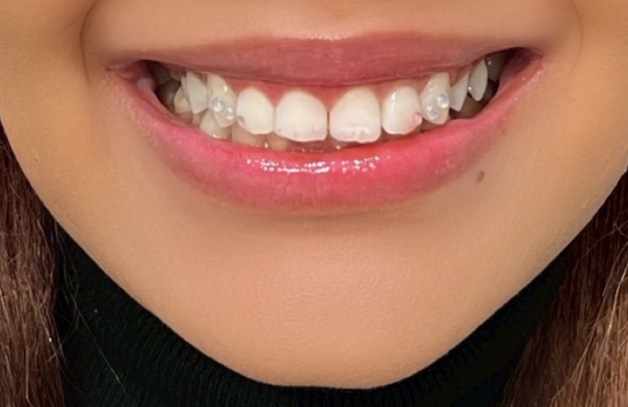 ティースジュエリー症例10