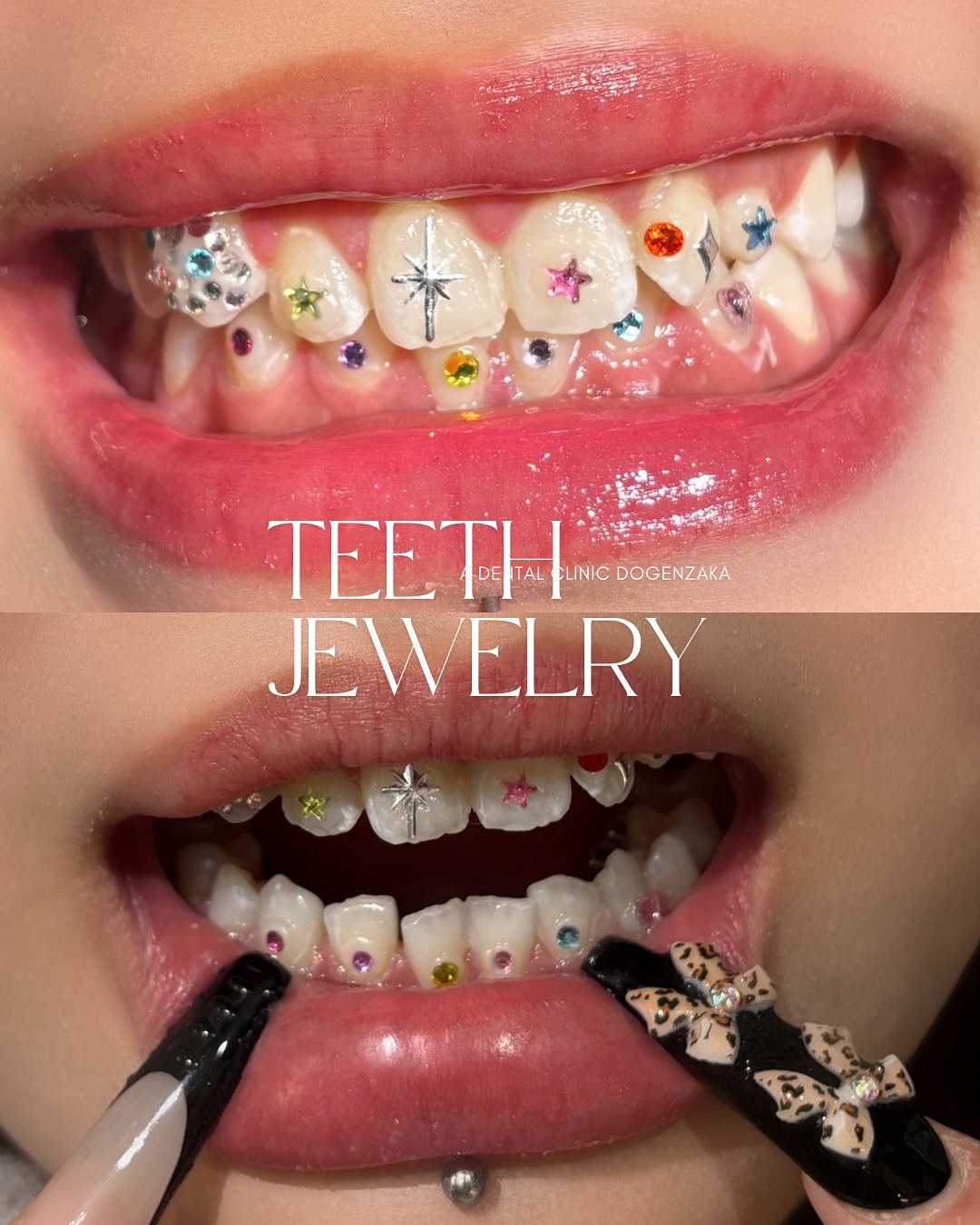 ティースジュエリー症例11