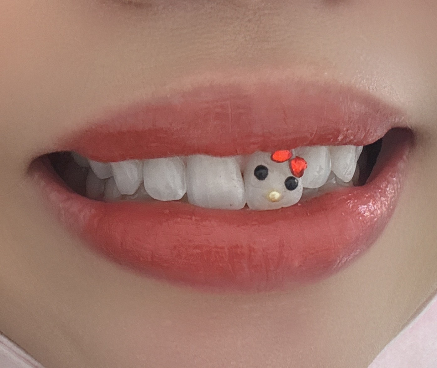 ティースジュエリー症例12