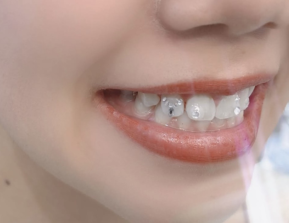 ティースジュエリー症例13