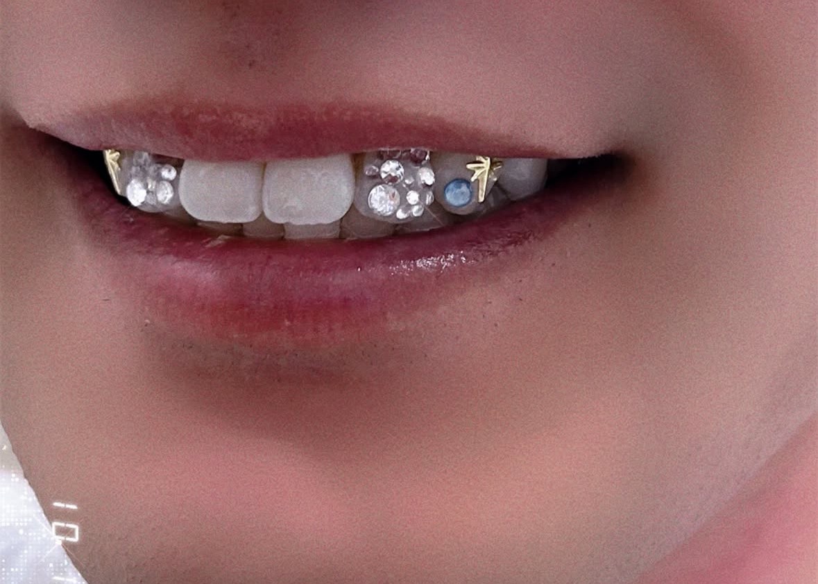 ティースジュエリー症例14