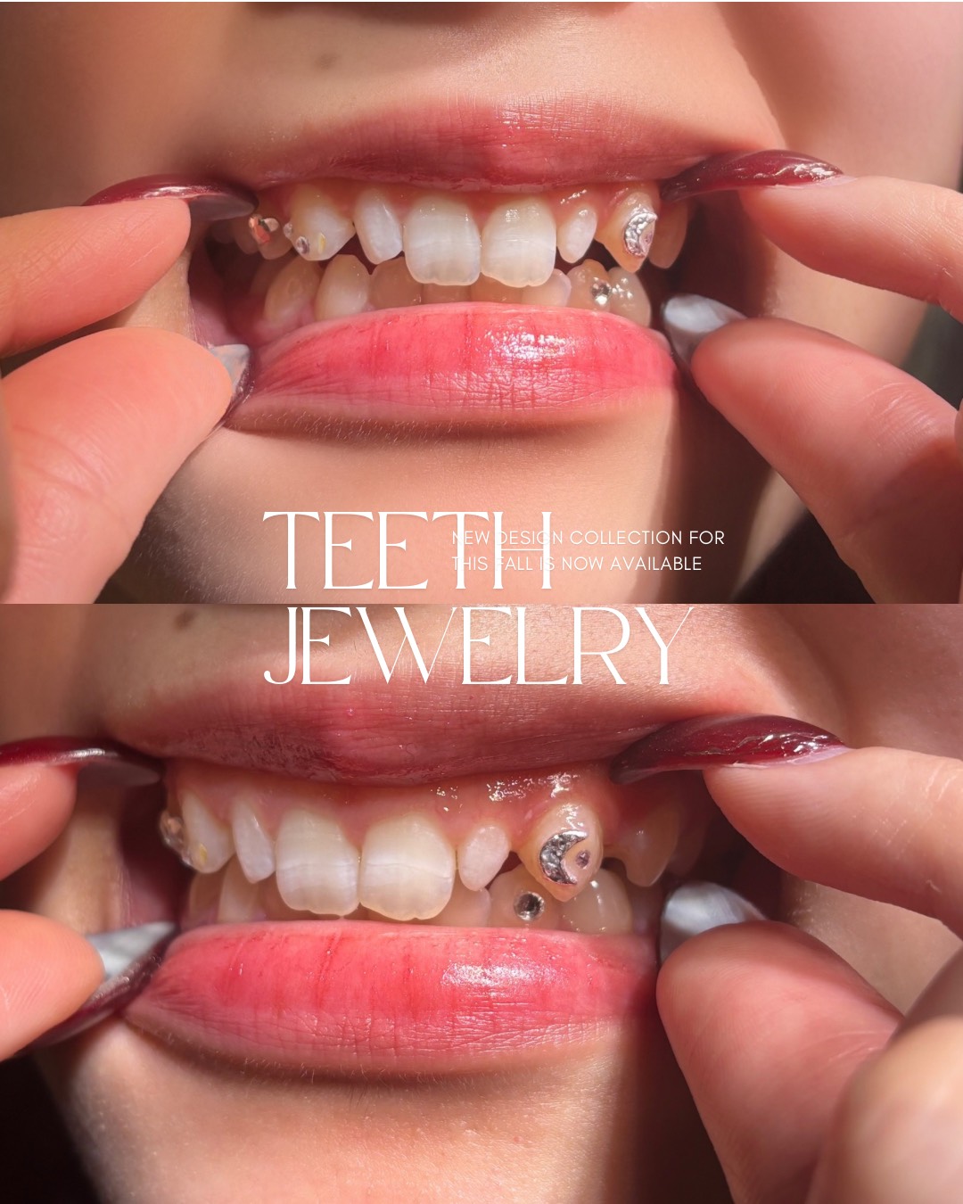 ティースジュエリー症例2