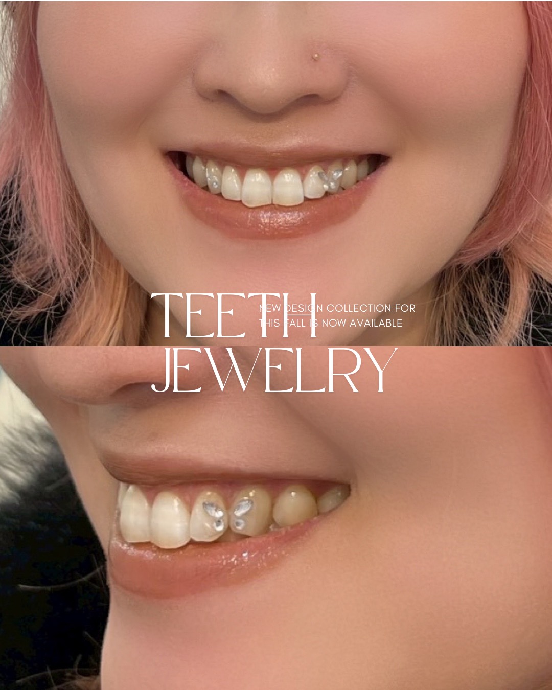 ティースジュエリー症例3