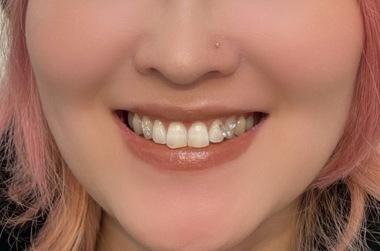 ティースジュエリー症例4