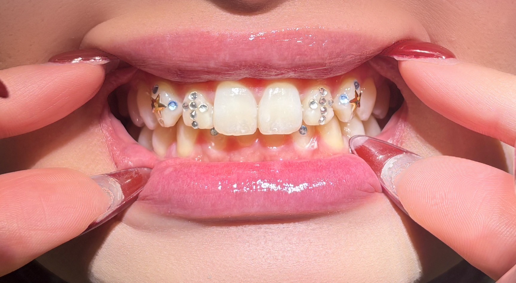 ティースジュエリー症例5