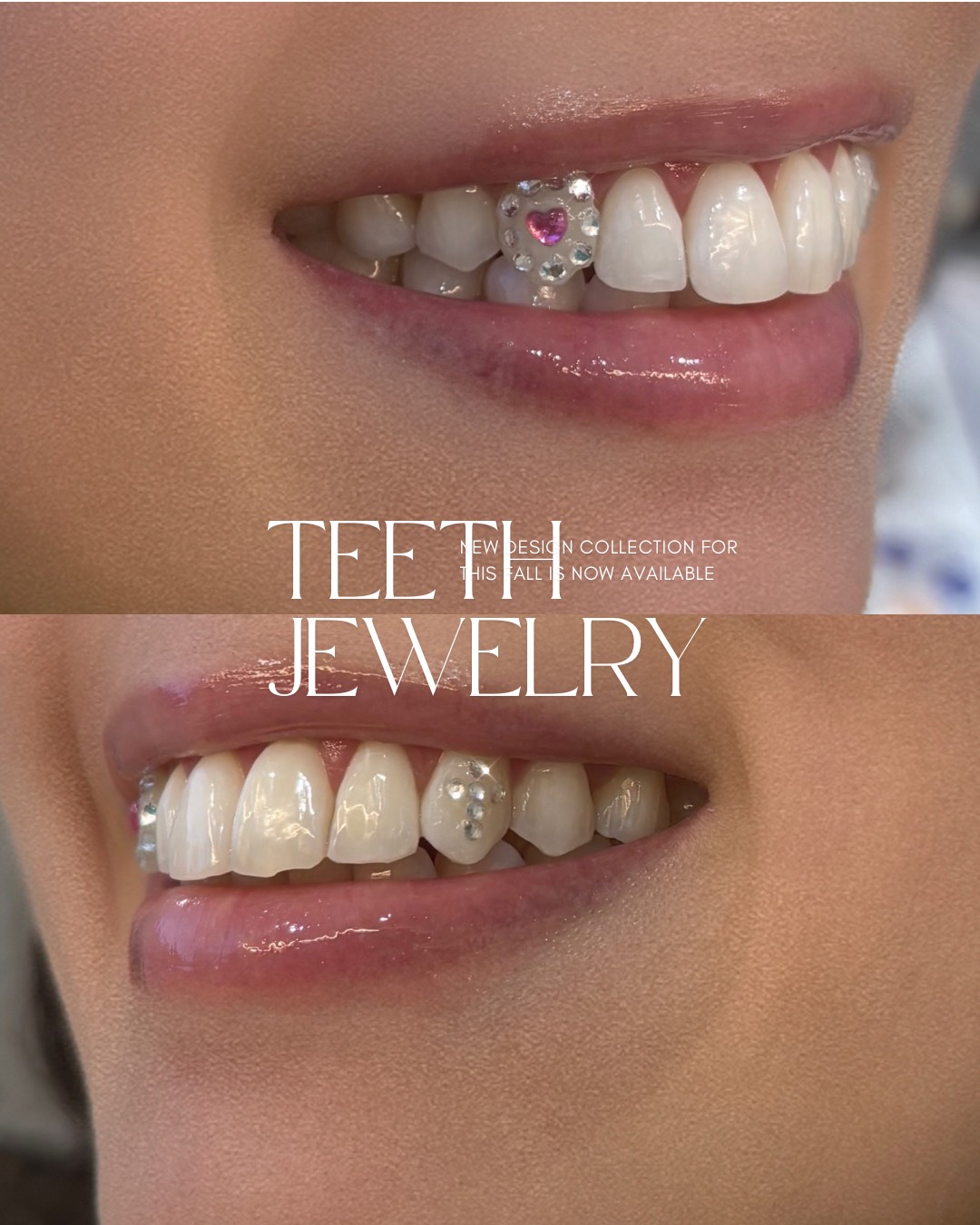 ティースジュエリー症例6