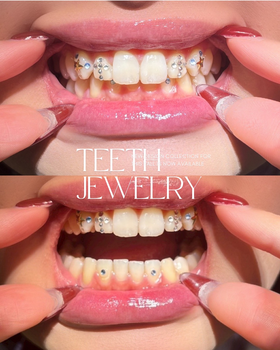 ティースジュエリー症例7