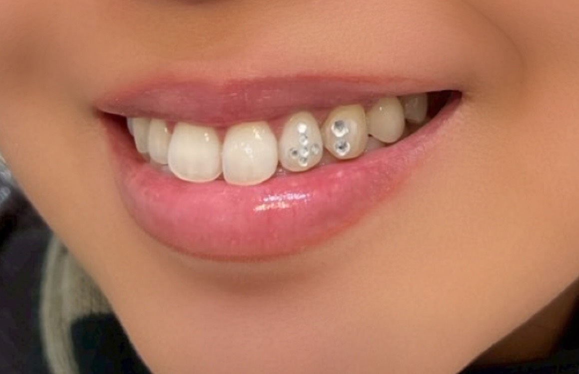 ティースジュエリー症例8