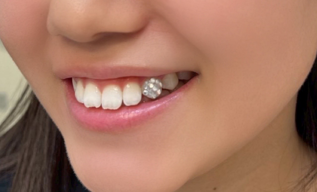 ティースジュエリー症例9